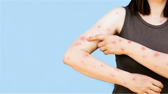 Conocida técnicamente como Mpox, la viruela del mono es una zoonosis viral poco frecuente